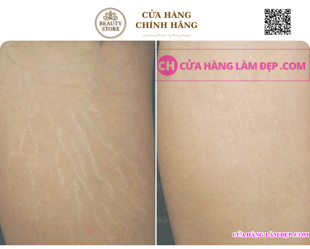 Tinh Chất Trị Rạn Nứt Da Toàn Thân Murad Cellulite Firm and Tone Serum