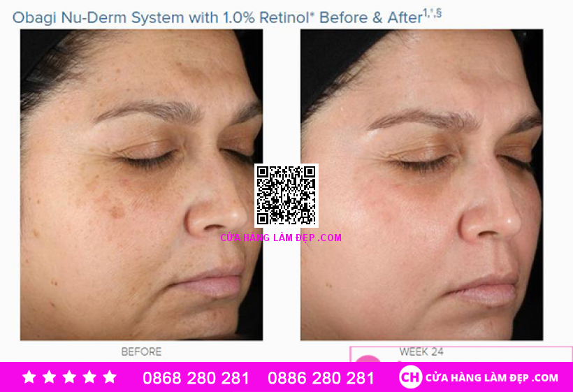 Kem dưỡng da Đẹp Da, ngừa mụn, cân bằng sắc tố da Obagi 360 Retinol 1.0%