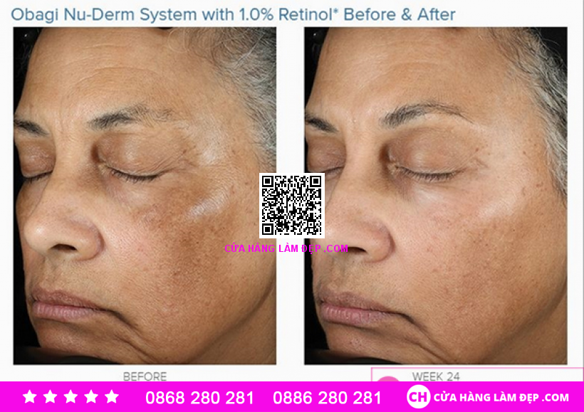 Kem dưỡng da Đẹp Da, ngừa mụn, cân bằng sắc tố da Obagi 360 Retinol 1.0%