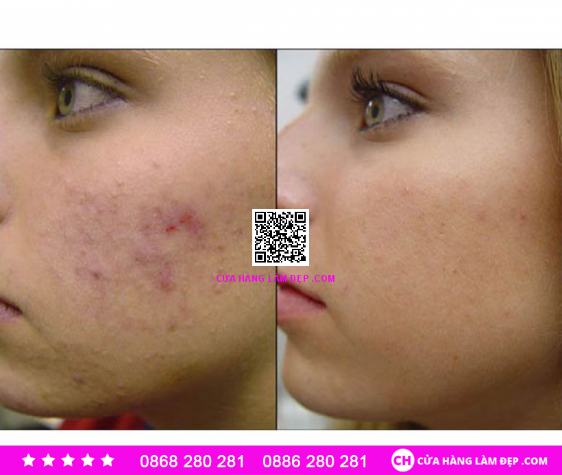 Kem Giảm Mụn Obagi Cream USP 0.1%