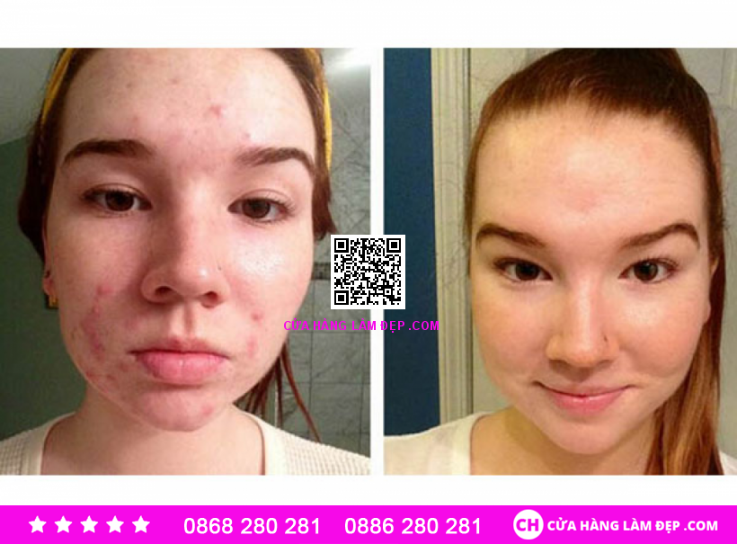 Kem Giảm Mụn, Làm Sáng Da Obagi T.R.E Cream USP 0.05%