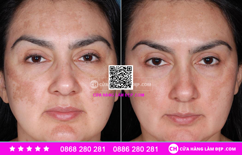 Kem Hỗ Trợ Mờ Nám Obagi Nu-derm Clear Fx