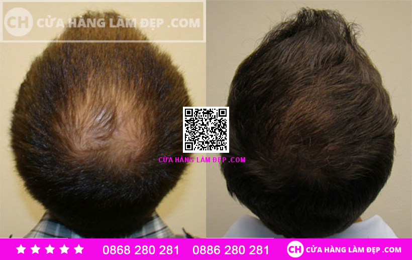 Tinh Chất Kích Thích Mọc Tóc Thảo Dược AROVICS Nhật Bản
