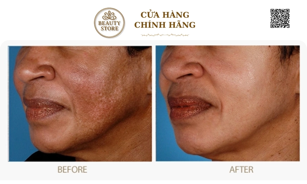 Kem đặc Mờ Nám ZO Melamin Skin Bleaching Crème
