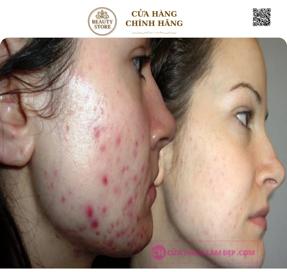 Kem Giảm Mụn, Lão Hoá Da Obagi T.R.E Cream USP 0,025%