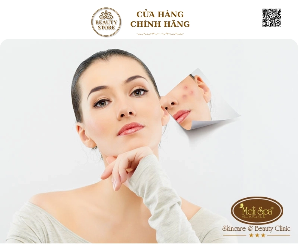Chăm Sóc Da Mặt Dành Cho Da Nám - Tàn Nhang tại Meli Spa