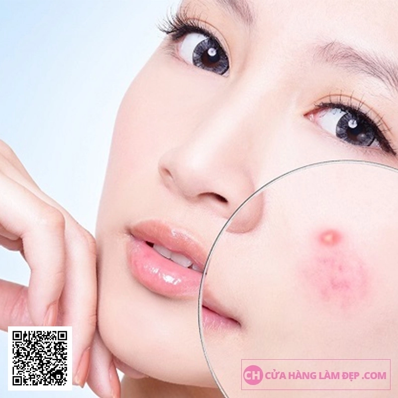 Liệu Trình Điều giảm Mụn Chuyên Sâu Bằng Công Nghệ Cao tại Meli Spa