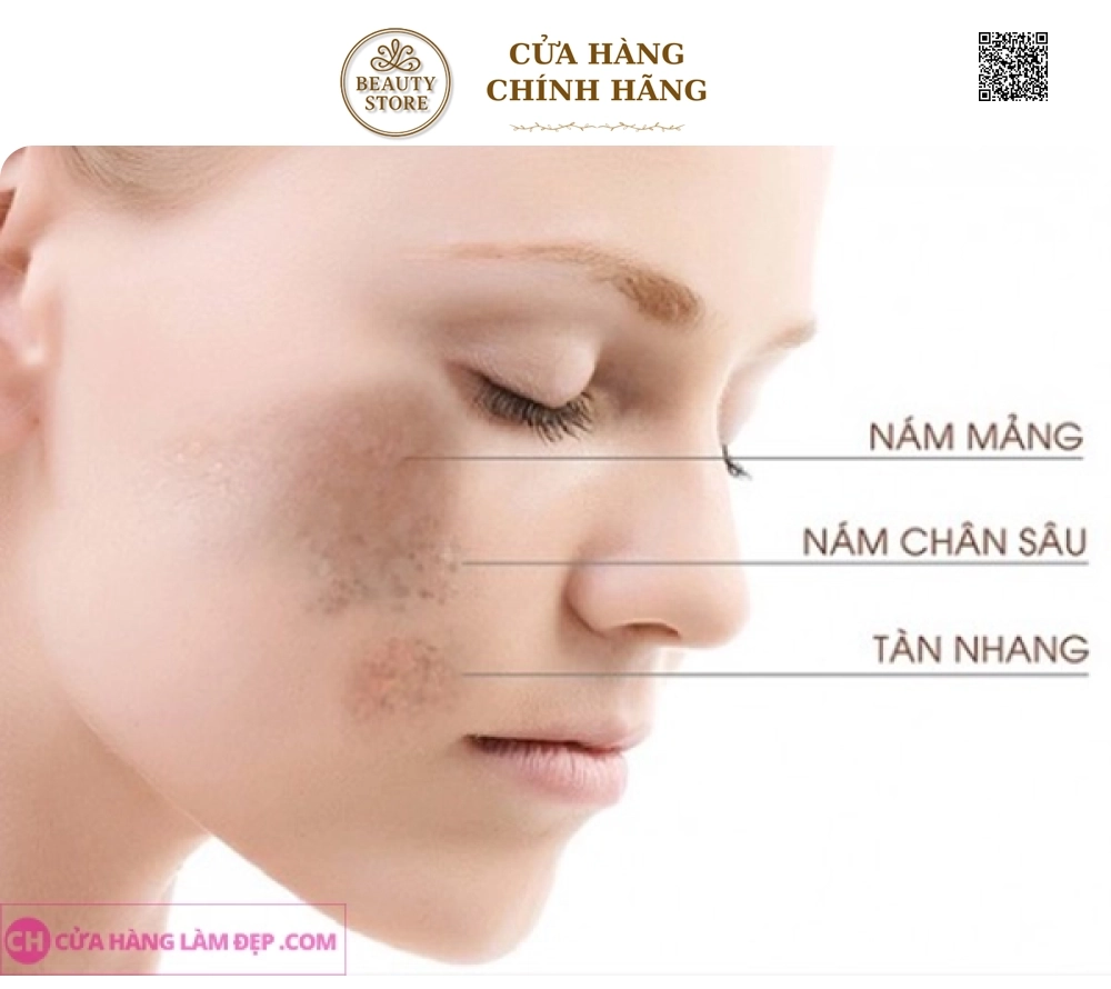 Liệu Trình Mờ Nám Bằng Tinh Chất Đặc giảm, Cắt Chân Nám tại Meli Spa