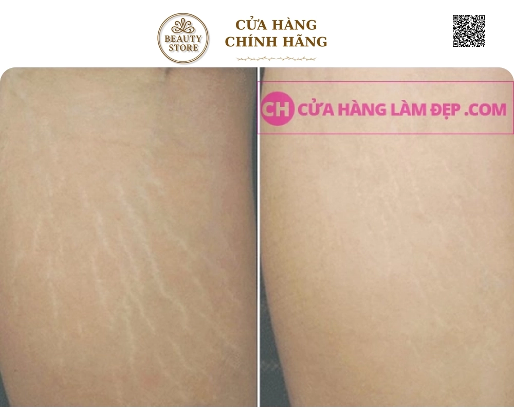 Tinh Chất Trị Rạn Nứt Da Toàn Thân Murad Cellulite Firm and Tone Serum