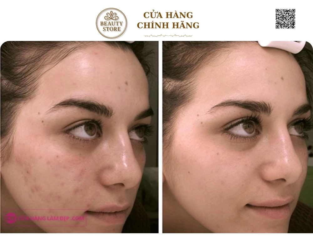 Kem Giảm Mụn Chuyên Biệt La Roche-Posay Effaclar Effaclar A.I.